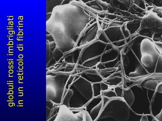 globuli rossi imbrigliati in un reticolo di fibrina 