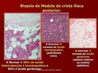 Biopsia de Medula da crista ilíaca
                           posterior:




                                        Anormal 
                                     excesso de tecido
                                      hematopoético         Anormal 
                                       (policitemia      excesso de tecido
                                          vera).            gorduroso
                                                         (aplasia medular
     Normal  50% do tecido                                ou anemia
intertrabecular é hematopoético e                           aplástica).
     50% é tecido gorduroso.Dra. Rita Mousinho Ribeiro
                         Profa.
 