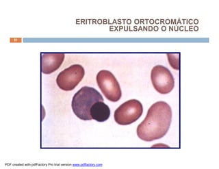 51
ERITROBLASTO ORTOCROMÁTICO
EXPULSANDO O NÚCLEO
PDF created with pdfFactory Pro trial version www.pdffactory.com
 