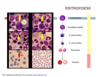 Proeritroblasto
Eritroblasto basófilo
E. policromático
E. ortocromático
Reticulócito
Hemácia
55
ERITROPOESE
PDF created with pdfFactory Pro trial version www.pdffactory.com
 
