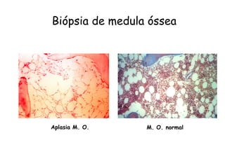 Biópsia de medula óssea




Aplasia M. O.    M. O. normal
 
