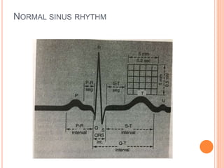 Sa Node Normal Rhythm SA Node Dysrhythmia | PPTX