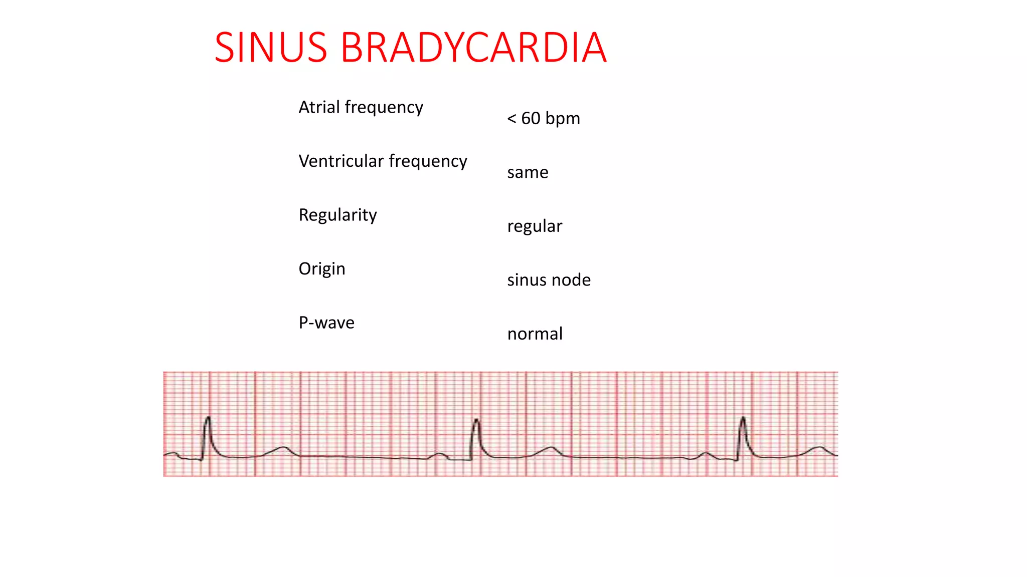 Atrial frequency
< 60 bpm
Ventricular frequency
same
Regularity
regular
Origin
sinus node
P-wave
normal
SINUS BRADYCARDIA
 