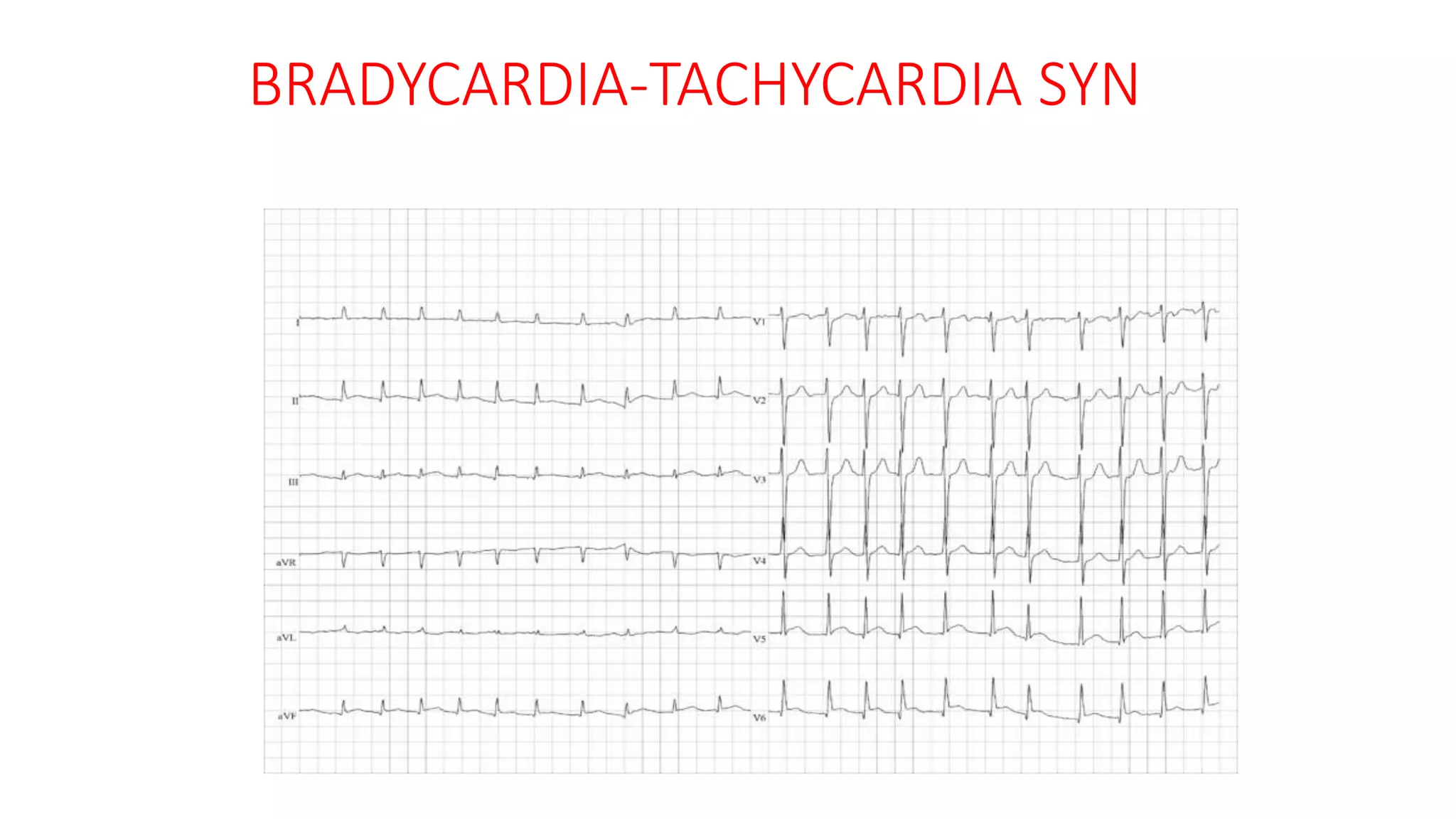 BRADYCARDIA-TACHYCARDIA SYN
 