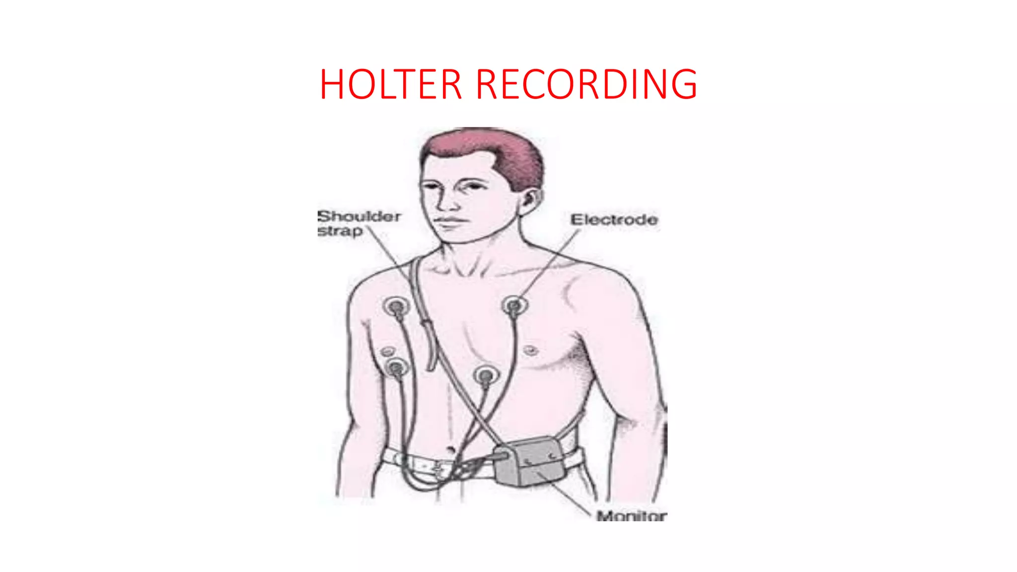 HOLTER RECORDING
 