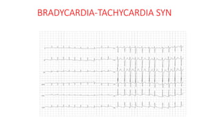 BRADYCARDIA-TACHYCARDIA SYN
 
