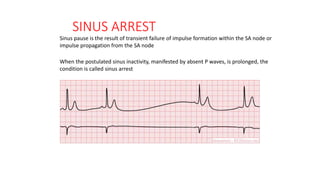 SINUS ARREST
Sinus pause is the result of transient failure of impulse formation within the SA node or
impulse propagation from the SA node
When the postulated sinus inactivity, manifested by absent P waves, is prolonged, the
condition is called sinus arrest
 