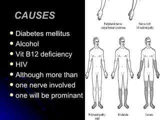 CAUSES Diabetes mellitus Alcohol Vit B12 deficiency HIV Although more than  one nerve involved  one will be prominant 