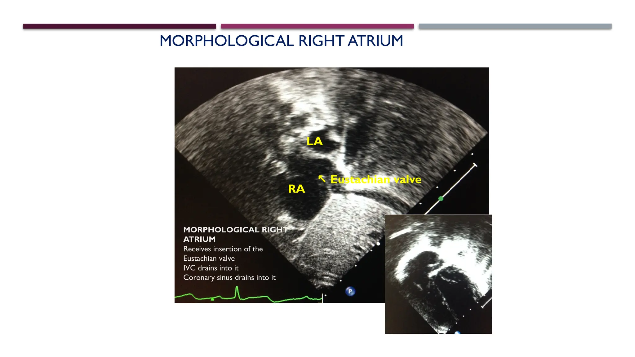Eustachian Ridge SEGMENTAL ANALYSIS of cardiac defects ppt | PPTX