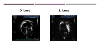 L Loop Lab Test SEGMENTAL ANALYSIS of cardiac defects ppt | PPTX