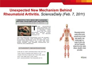 Unexpected New Mechanism Behind  Rheumatoid Arthritis .  ScienceDaily (Feb. 7, 2011)   