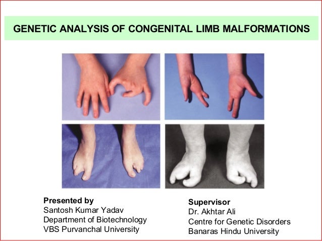 Congenital Limb Abnormalities | Congenital Limb Defects – MAXLUA