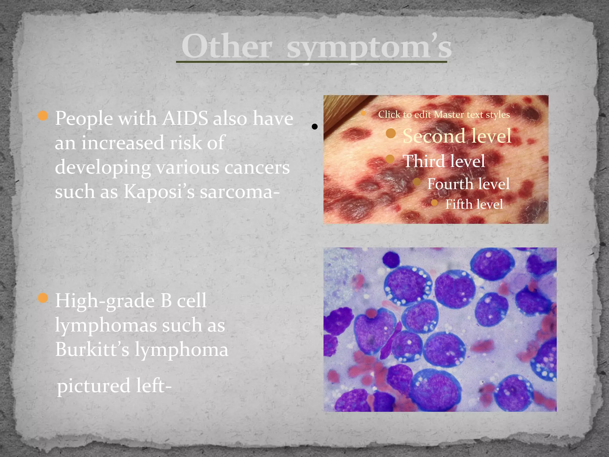 Other symptom’s
 People with AIDS also have          Click to edit Master text styles
                               •         Second level
  an increased risk of
                                         Third level
  developing various cancers
                                                Fourth level
  such as Kaposi’s sarcoma-                         Fifth level




 High-grade B cell
  lymphomas such as
  Burkitt’s lymphoma
  pictured left-
 