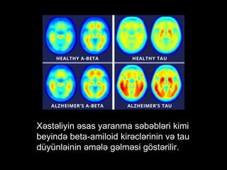Xəstəliyin əsas yaranma səbəbləri kimi
beyində beta-amiloid kirəclərinin və tau
düyünləinin əmələ gəlməsi göstərilir.
 