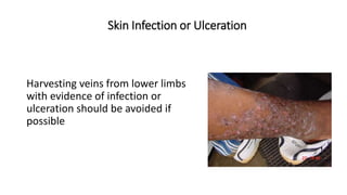 Harvesting veins from lower limbs
with evidence of infection or
ulceration should be avoided if
possible
Skin Infection or Ulceration
 