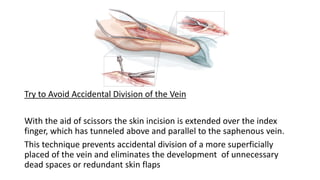 Try to Avoid Accidental Division of the Vein
With the aid of scissors the skin incision is extended over the index
finger, which has tunneled above and parallel to the saphenous vein.
This technique prevents accidental division of a more superficially
placed of the vein and eliminates the development of unnecessary
dead spaces or redundant skin flaps
 