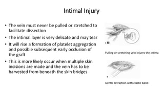 Intimal Injury
• The vein must never be pulled or stretched to
facilitate dissection
• The intimal layer is very delicate and may tear
• It will rise a formation of platelet aggregation
and possible subsequent early occlusion of
the graft
• This is more likely occur when multiple skin
incisions are made and the vein has to be
harvested from beneath the skin bridges
Pulling or stretching vein injures the intima
Gentle retraction with elastic band
 