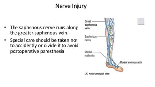 Nerve Injury
• The saphenous nerve runs along
the greater saphenous vein.
• Special care should be taken not
to accidently or divide it to avoid
postoperative paresthesia
 