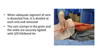 • When adequate segment of vein
is dissected free, it is divided at
each end and removed
• The vein stumps in the groin and
the ankle are securely ligated
with 3/0 Ethibond tie
 