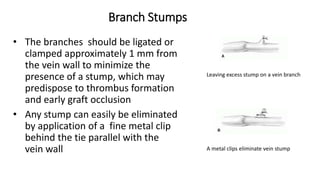 Branch Stumps
• The branches should be ligated or
clamped approximately 1 mm from
the vein wall to minimize the
presence of a stump, which may
predispose to thrombus formation
and early graft occlusion
• Any stump can easily be eliminated
by application of a fine metal clip
behind the tie parallel with the
vein wall
Leaving excess stump on a vein branch
A metal clips eliminate vein stump
 