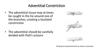 Adventitial Constriction
• The adventitial tissue may at times
be caught in the tie around one of
the branches, creating a localized
constriction
• The adventitial should be carefully
divided with Pott’s scissors
Dividing the adventitial band to relieve constriction
 