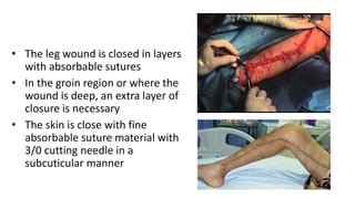 • The leg wound is closed in layers
with absorbable sutures
• In the groin region or where the
wound is deep, an extra layer of
closure is necessary
• The skin is close with fine
absorbable suture material with
3/0 cutting needle in a
subcuticular manner
 