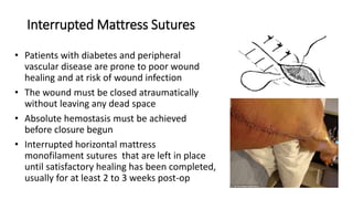 Interrupted Mattress Sutures
• Patients with diabetes and peripheral
vascular disease are prone to poor wound
healing and at risk of wound infection
• The wound must be closed atraumatically
without leaving any dead space
• Absolute hemostasis must be achieved
before closure begun
• Interrupted horizontal mattress
monofilament sutures that are left in place
until satisfactory healing has been completed,
usually for at least 2 to 3 weeks post-op
 
