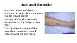Interrupted Skin Incision
• In patients who are diabetic or
peripheral vascular disease are prone
to poor wound healing
• Multiple skin incision are made,
leaving intervening bridges of skin
intact
• This allow better closure of the
wound and minimizes ischemic
changes along the skin edges
 