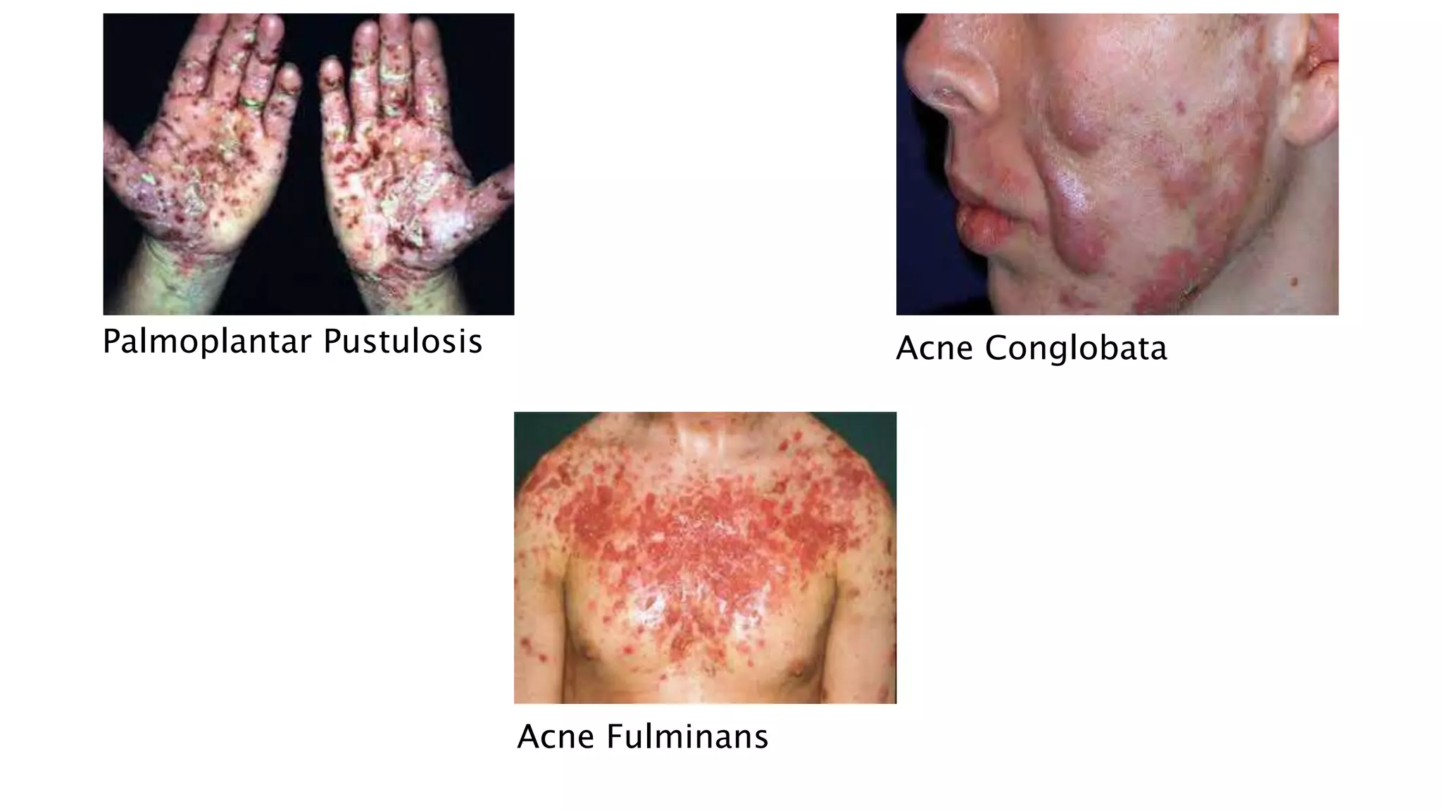 Palmoplantar Pustulosis Acne Conglobata
Acne Fulminans
 