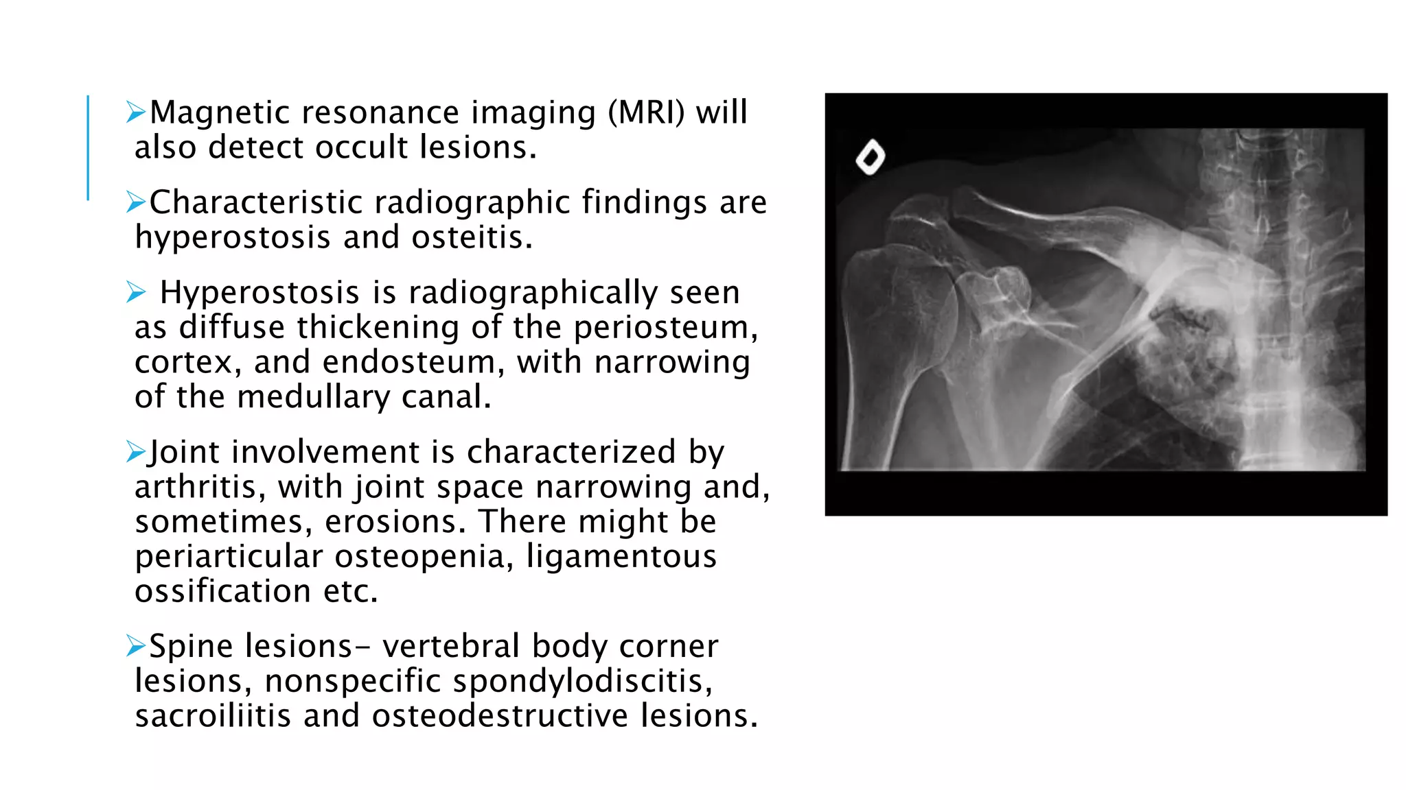 Magnetic resonance imaging (MRI) will
also detect occult lesions.
Characteristic radiographic findings are
hyperostosis and osteitis.
 Hyperostosis is radiographically seen
as diffuse thickening of the periosteum,
cortex, and endosteum, with narrowing
of the medullary canal.
Joint involvement is characterized by
arthritis, with joint space narrowing and,
sometimes, erosions. There might be
periarticular osteopenia, ligamentous
ossification etc.
Spine lesions- vertebral body corner
lesions, nonspecific spondylodiscitis,
sacroiliitis and osteodestructive lesions.
 