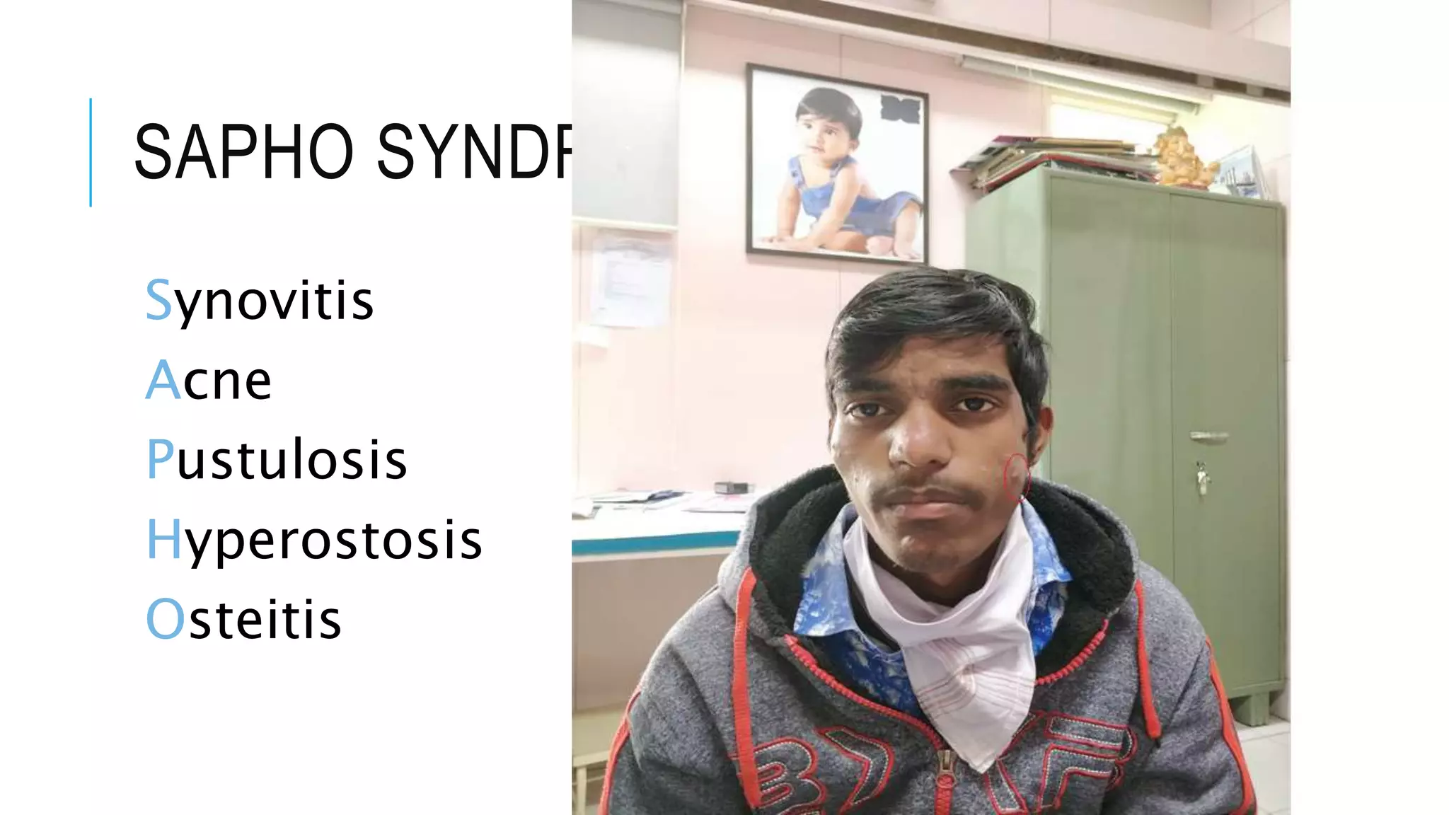 SAPHO SYNDROME
Synovitis
Acne
Pustulosis
Hyperostosis
Osteitis
 