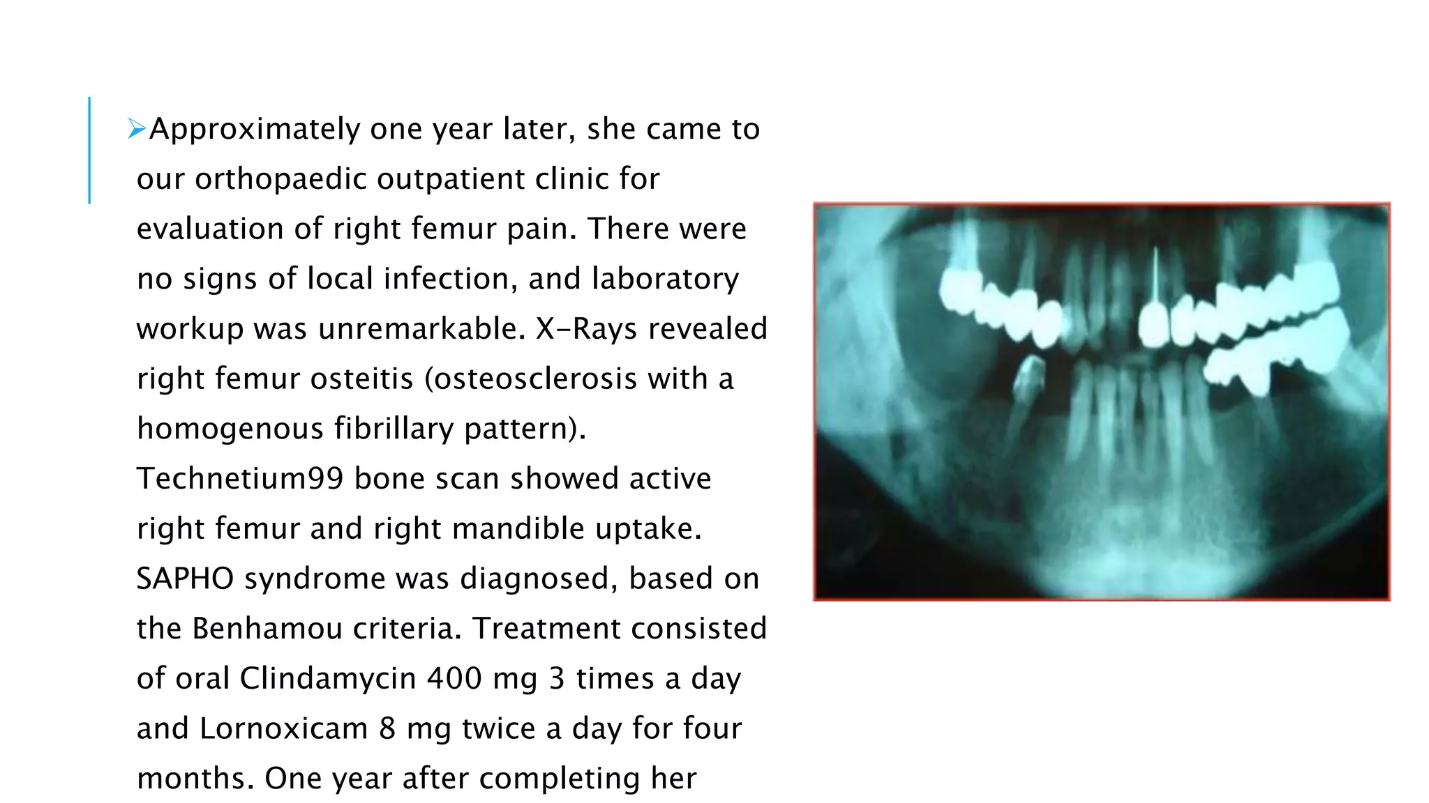 Approximately one year later, she came to
our orthopaedic outpatient clinic for
evaluation of right femur pain. There were
no signs of local infection, and laboratory
workup was unremarkable. X-Rays revealed
right femur osteitis (osteosclerosis with a
homogenous fibrillary pattern).
Technetium99 bone scan showed active
right femur and right mandible uptake.
SAPHO syndrome was diagnosed, based on
the Benhamou criteria. Treatment consisted
of oral Clindamycin 400 mg 3 times a day
and Lornoxicam 8 mg twice a day for four
months. One year after completing her
 