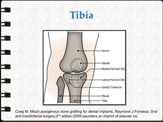 Tibia
Craig M. Misch,autogenous bone grafting for dental implants, Raymond J Fonseca; Oral
and maxillofacial surgery;2nd edition:2009;saunders an imprint of elsevier inc.
 