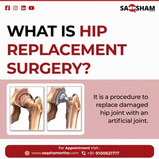 WHAT IS HIP
REPLACEMENT
SURGERY?
It is a procedure to
replace damaged
hip joint with an
artiﬁcial joint.
 