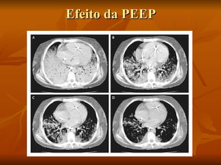 Efeito da PEEP 