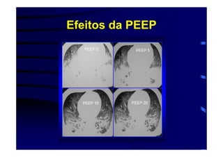 Efeitos da PEEP
 