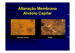 Alteração Membrana
   Alvéolo Capilar
 