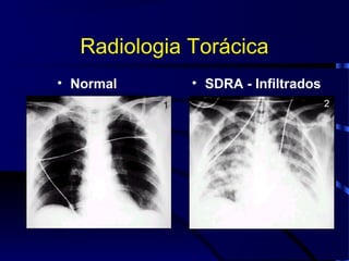 Radiologia Torácica
• Normal      • SDRA - Infiltrados
 