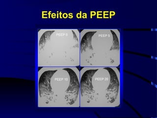 Efeitos da PEEP
 