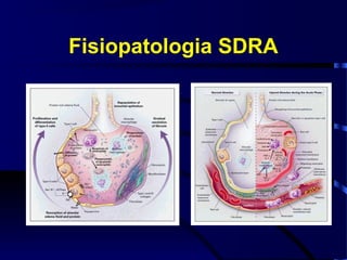 Fisiopatologia SDRA
 