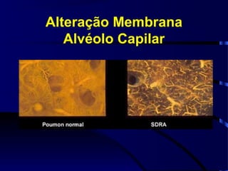 Alteração Membrana
   Alvéolo Capilar
 