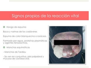 Signos propios de la reacción vital
 Hongo de espuma
Boca y narinas de los cadáveres
Espuma de color blanquecina o rosácea.
Formado por agua, proteínas plasmáticas
y agentes tensoactivos.
 Manchas equimóticas
- Manchas de Tardieu
- Se ven en conjuntiva, piel palpebral y
mucosa de cavidad oral.
 