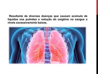 Resultante de diversas doenças que causam acúmulo de
líquidos nos pulmões e redução do oxigênio no sangue a
níveis excessivamente baixos.
 