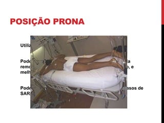 POSIÇÃO PRONA
Utilizar na SARA moderada.
Pode ser mais fisiológico e resultar na melhoria da
remoção de secreção, melhor ventilação/perfusão, e
melhor aeração as unidades de pulmão dorsal.
Pode também diminuir a sobrecarga de VD nos casos de
SARA grave.
 
