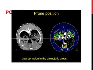 POSIÇÃO PRONA
Utilizar na SARA moderada.
Pode ser mais fisiológico e resultar na melhoria da
remoção de secreção, melhor ventilação/perfusão, e
melhor aeração as unidades de pulmão dorsal.
Pode também diminuir a sobrecarga de VD nos casos de
SARA grave.
 