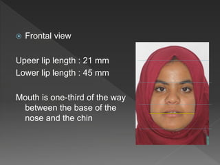 Frontal view
Upeer lip length : 21 mm
Lower lip length : 45 mm
Mouth is one-third of the way
between the base of the
nose and the chin
 