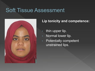 Lip tonicity and competence:
• thin upper lip.
• Normal lower lip.
• Potentially competent
unstrained lips.
 