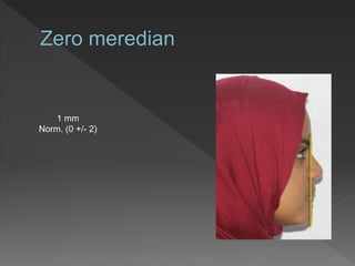 1 mm
Norm. (0 +/- 2)
 