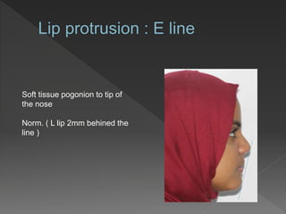 Soft tissue pogonion to tip of
the nose
Norm. ( L lip 2mm behined the
line )
 