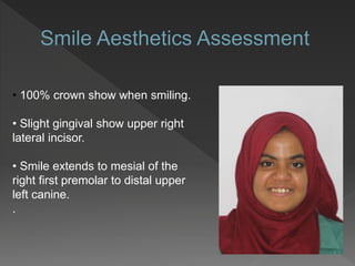• 100% crown show when smiling.
• Slight gingival show upper right
lateral incisor.
• Smile extends to mesial of the
right first premolar to distal upper
left canine.
.
 